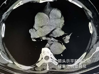 CT检查中的“意外”发现-医路上